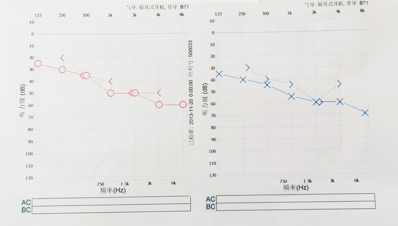 助听器验配常识:教你通过听力图看自己的听损性质 助听器验配常识:教你通过听力图看自己的听损性质