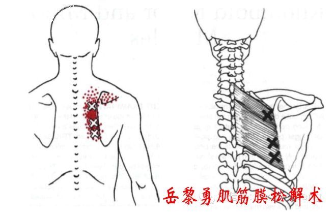 岳家草堂肌筋膜松解