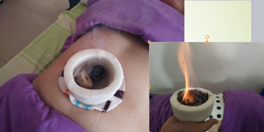 脐灸脐疗，隔盐灸